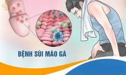 Điều trị sùi mào gà có khó không?